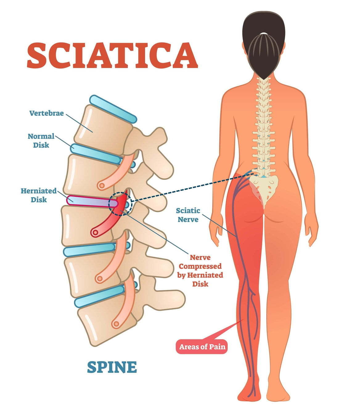 Sciatica Pain Relief 10 Quick Ways 